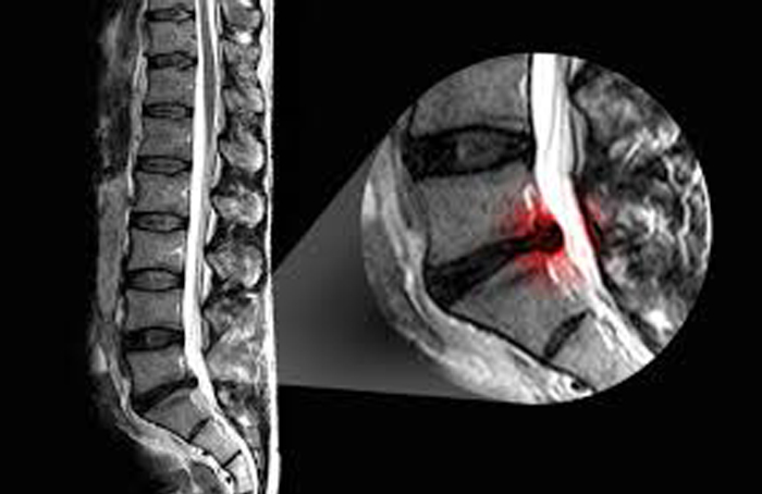 درمان انواع کمر درد ، سیاتیک ، دیسک های اسیب دیده و پاره با روش MDT درمان انواع کمر درد ، سیاتیک ، دیسک های اسیب دیده و پاره با روش MDT
